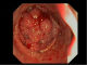 Adenocarcinoma in the colon