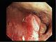 Adenocarcinoma in the colon