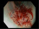 Lateral-spreading tumor in colon