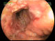 Ileal stricture in Crohns disease